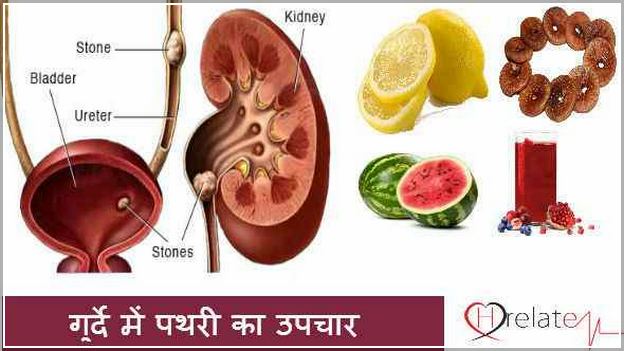 Kidney Stone Pain Relief In Hindi
