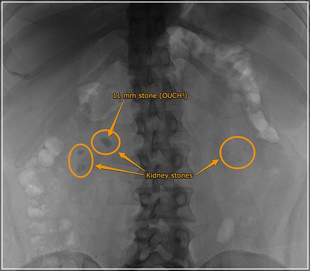 Kidney Stone Pain Relief Injection